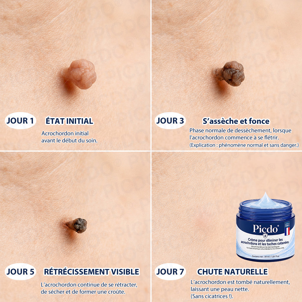 🌌𝐏𝐢𝐜𝐝𝐨® 𝐂𝐫è𝐦𝐞 𝐄𝐟𝐟𝐚𝐜𝐞𝐮𝐫 𝐝’𝐀𝐜𝐫𝐨𝐜𝐡𝐨𝐫𝐝𝐨𝐧𝐬 & 𝐝𝐞 𝐓𝐚𝐜𝐡𝐞𝐬 – 𝟕 𝐉𝐨𝐮𝐫𝐬(𝐅𝐨𝐫𝐦𝐮𝐥𝐞 𝐙é𝐫𝐨 𝐃𝐨𝐮𝐥𝐞𝐮𝐫, 𝐙é𝐫𝐨 𝐂𝐢𝐜𝐚𝐭𝐫𝐢𝐜𝐞)💥