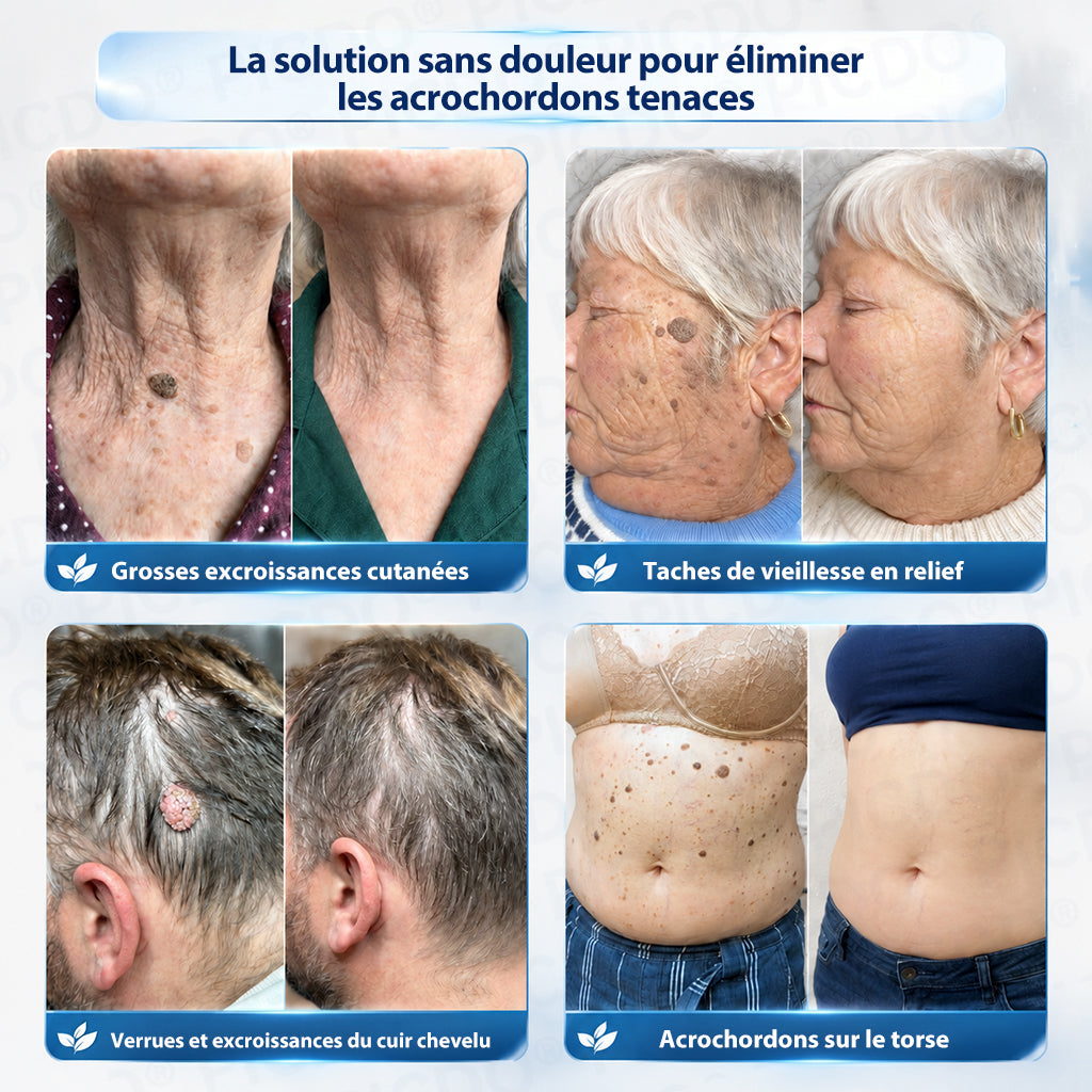 🌌𝐏𝐢𝐜𝐝𝐨® 𝐂𝐫è𝐦𝐞 𝐄𝐟𝐟𝐚𝐜𝐞𝐮𝐫 𝐝’𝐀𝐜𝐫𝐨𝐜𝐡𝐨𝐫𝐝𝐨𝐧𝐬 & 𝐝𝐞 𝐓𝐚𝐜𝐡𝐞𝐬 – 𝟕 𝐉𝐨𝐮𝐫𝐬(𝐅𝐨𝐫𝐦𝐮𝐥𝐞 𝐙é𝐫𝐨 𝐃𝐨𝐮𝐥𝐞𝐮𝐫, 𝐙é𝐫𝐨 𝐂𝐢𝐜𝐚𝐭𝐫𝐢𝐜𝐞)💥