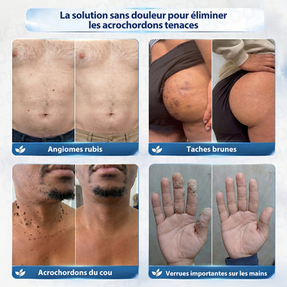 🌌𝐏𝐢𝐜𝐝𝐨® 𝐂𝐫è𝐦𝐞 𝐄𝐟𝐟𝐚𝐜𝐞𝐮𝐫 𝐝’𝐀𝐜𝐫𝐨𝐜𝐡𝐨𝐫𝐝𝐨𝐧𝐬 & 𝐝𝐞 𝐓𝐚𝐜𝐡𝐞𝐬 – 𝟕 𝐉𝐨𝐮𝐫𝐬(𝐅𝐨𝐫𝐦𝐮𝐥𝐞 𝐙é𝐫𝐨 𝐃𝐨𝐮𝐥𝐞𝐮𝐫, 𝐙é𝐫𝐨 𝐂𝐢𝐜𝐚𝐭𝐫𝐢𝐜𝐞)💥
