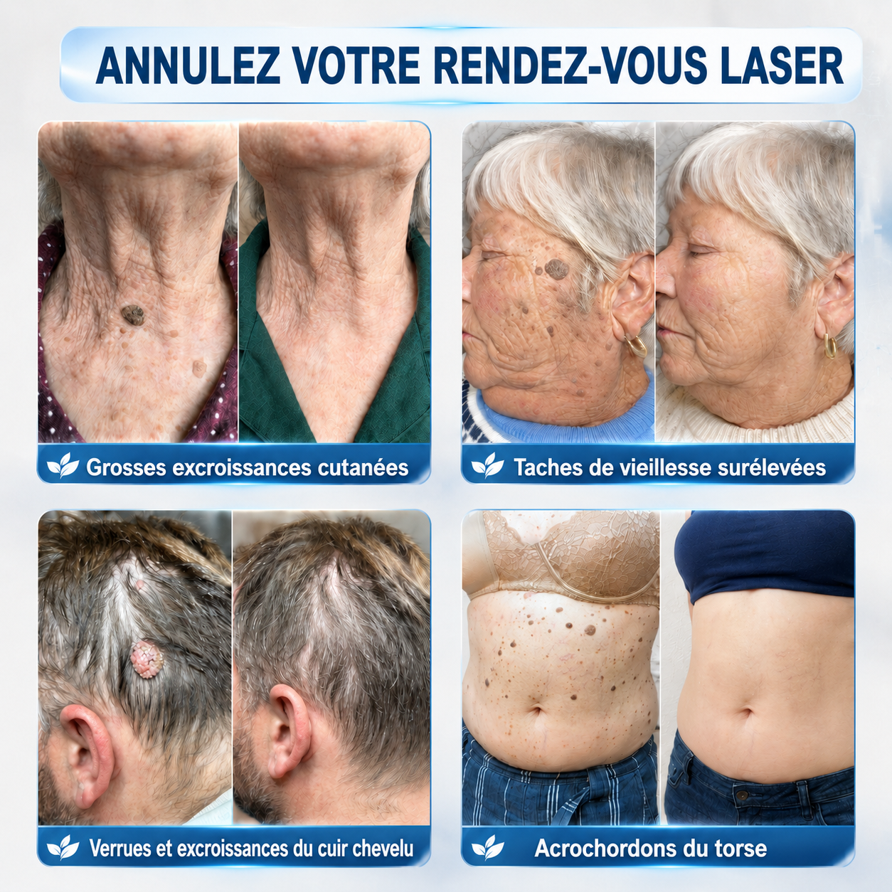 👩‍⚕️🎉 𝐵𝑜𝑢𝑡𝑖𝑞𝑢𝑒 𝑂𝑓𝑓𝑖𝑐𝑖𝑒𝑙𝑙𝑒 | 𝑵𝐞𝒌𝐢𝐬𝐬® 🌿𝑴𝒊𝒄𝒓𝒐𝒏𝒆𝒆𝒅𝒍𝒆𝒔 𝑷𝒆𝒂𝒖 𝑷𝒂𝒓𝒇𝒂𝒊𝒕𝒆 É𝒍𝒊𝒎𝒊𝒏𝒂𝒕𝒊𝒐𝒏 𝑫𝒆𝒔 𝑽𝒆𝒓𝒓𝒖𝒆𝒔 𝑷𝒂𝒕𝒄𝒉 (𝑃𝑜𝑢𝑟 𝑙𝑒𝑠 𝑎𝑐𝑟𝑜𝑐ℎ𝑜𝑟𝑑𝑜𝑛𝑠, 𝑙𝑒𝑠 𝑝𝑒𝑡𝑖𝑡𝑒𝑠 𝑒𝑥𝑐𝑟𝑜𝑖𝑠𝑠𝑎𝑛𝑐𝑒𝑠 𝑐𝑢𝑡𝑎𝑛é𝑒𝑠, 𝑙𝑒𝑠 𝑣𝑒𝑟𝑟𝑢𝑒𝑠, 𝑙𝑒𝑠 𝑔𝑟𝑎𝑖𝑛𝑠 𝑑𝑒 𝑏𝑒𝑎𝑢𝑡é, 𝑙𝑒𝑠 𝑡𝑎𝑐ℎ𝑒𝑠 𝑑𝑒 𝑣𝑖𝑒𝑖𝑙𝑙𝑒𝑠𝑠𝑒 𝑒𝑡 𝑙𝑒𝑠 𝑝𝑟𝑜𝑏𝑙è𝑚𝑒𝑠 𝑑𝑒 𝑝𝑖𝑔𝑚𝑒𝑛𝑡𝑎𝑡𝑖𝑜𝑛)